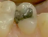 amalgamfuellung